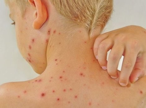 Vlada HNŽ upozorila na pojavu morbila, građani pozvani na odgovornost